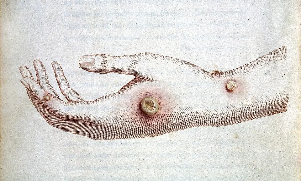 La main de Sarah Nelmes, atteinte de la vaccine (la variole de la vache) : planche de l’ouvrage d’Edward Jenner, An Inquiry into the Causes and Effects of the Variolæ Vaccinæ.
