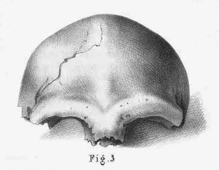The skullcap of Neandertal 1, in a lithograph published by Johann Carl Fuhlrott in 1859. The first Neanderthal DNA, read in 1997, came from an arm bone of the same individual, found in 1856.